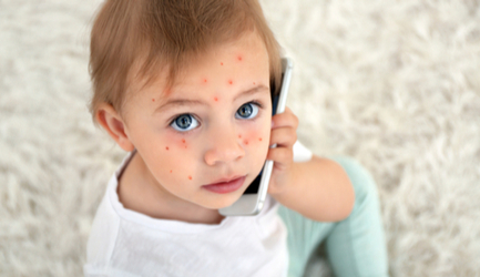 אבעבועות רוח - תמונת המחשה